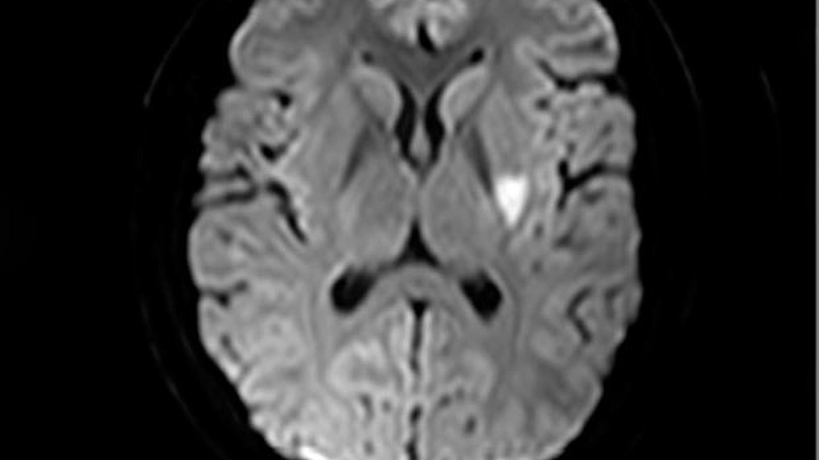 Magnetisk resonans-skanning af cerebrum med diffusionsvægtede sekvenser. Der ses et af tre friske cerebrale infarkter, her i venstre basalganglieområde, hos 17-årig mand, som var i behandling med lisdexamfetamin og sertralin. 