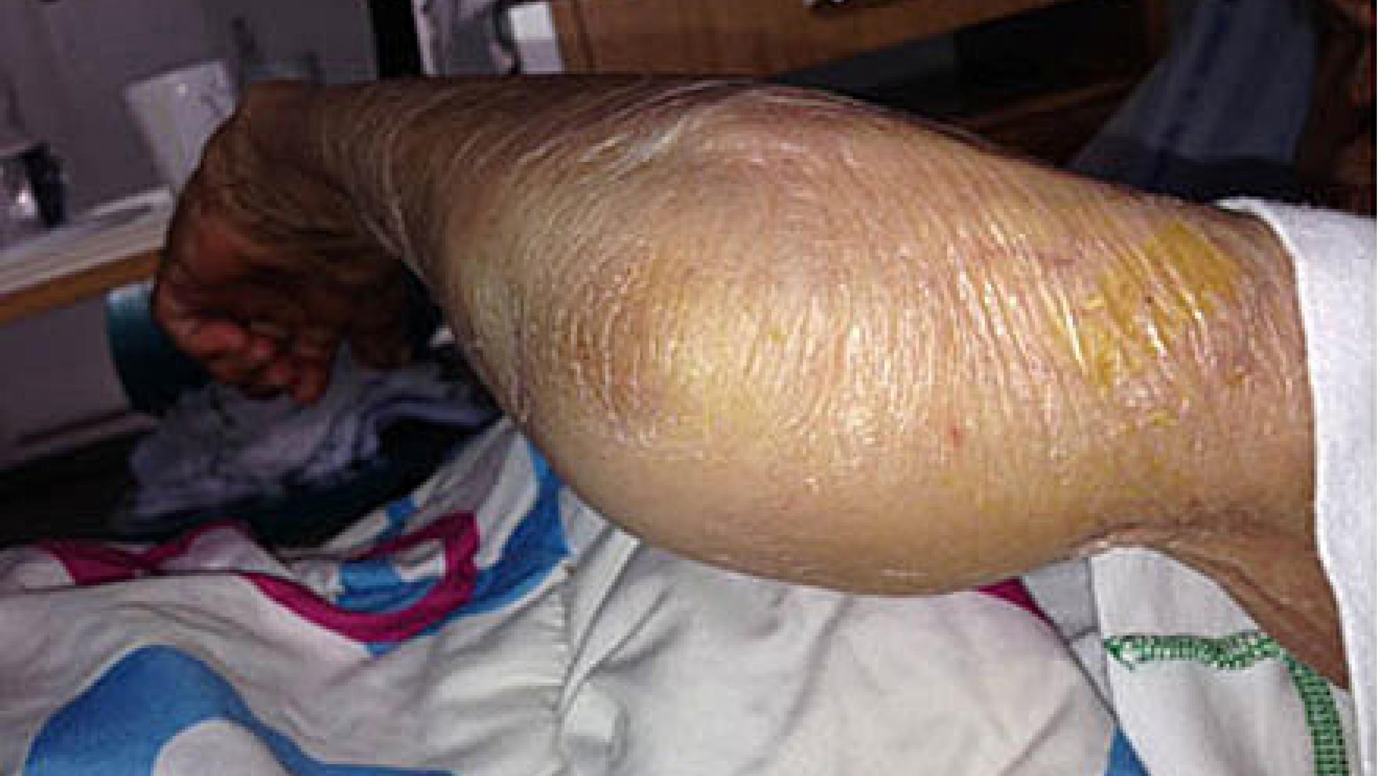 Monoartikulær septisk artritis i venstre albueled