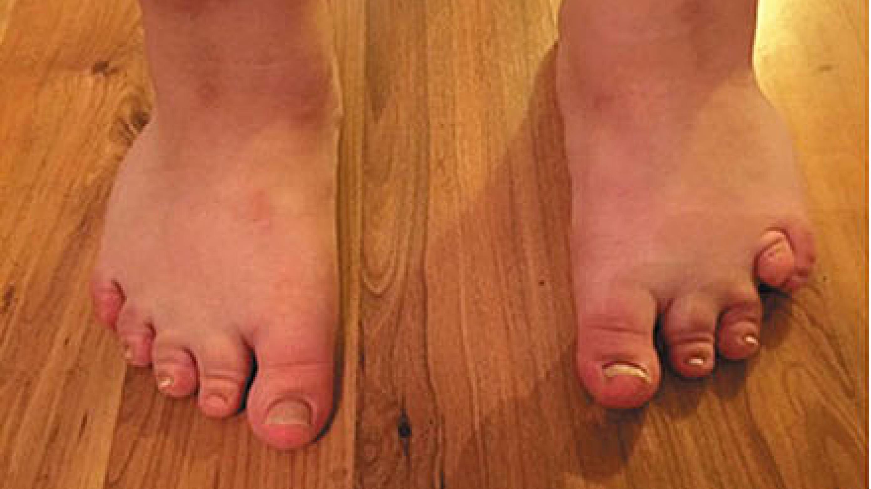 På billedet ses en karakteristisk kort fjerde tå (brakydaktyli) på venstre fod hos sygehistoriens patient med Albrights hereditære osteodystrofi.