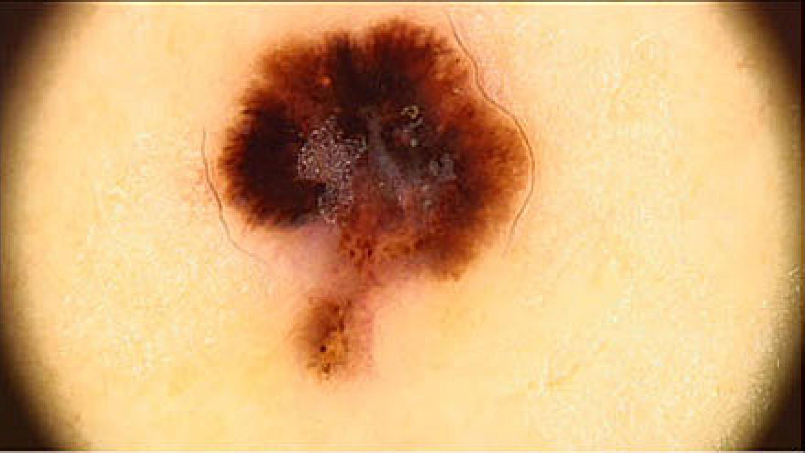 Malignt melanom. (Foto: Georg Authried, Dermatologisk Afdeling, Odense Universitetshospital).