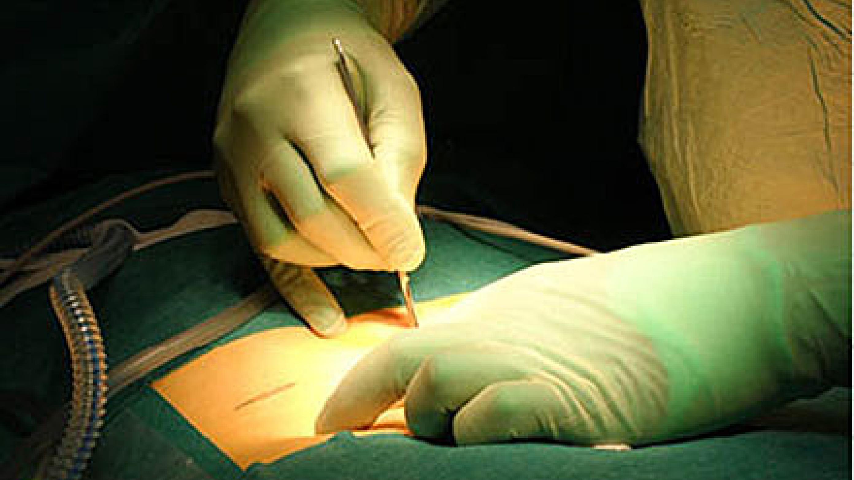 Kirurgisk behandling af lumbal diskusprolaps.