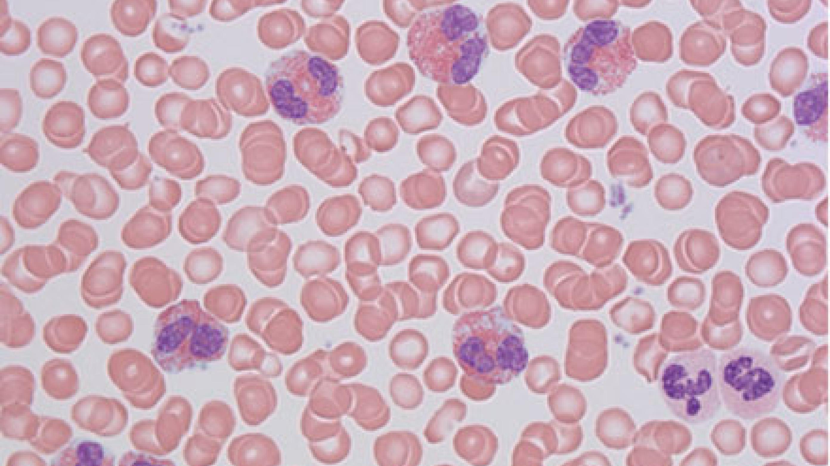 Udstryg af perifert blod fra en patient med sekundær (reaktiv) eosinofili set i lysmikroskop, ca. 200 × forstørrelse, May-Grünwald-Giemsa-farvning. Der ses otte eosinofile granulocytter, karakteristisk med bilobær kerne og kraftigt røde granula. 