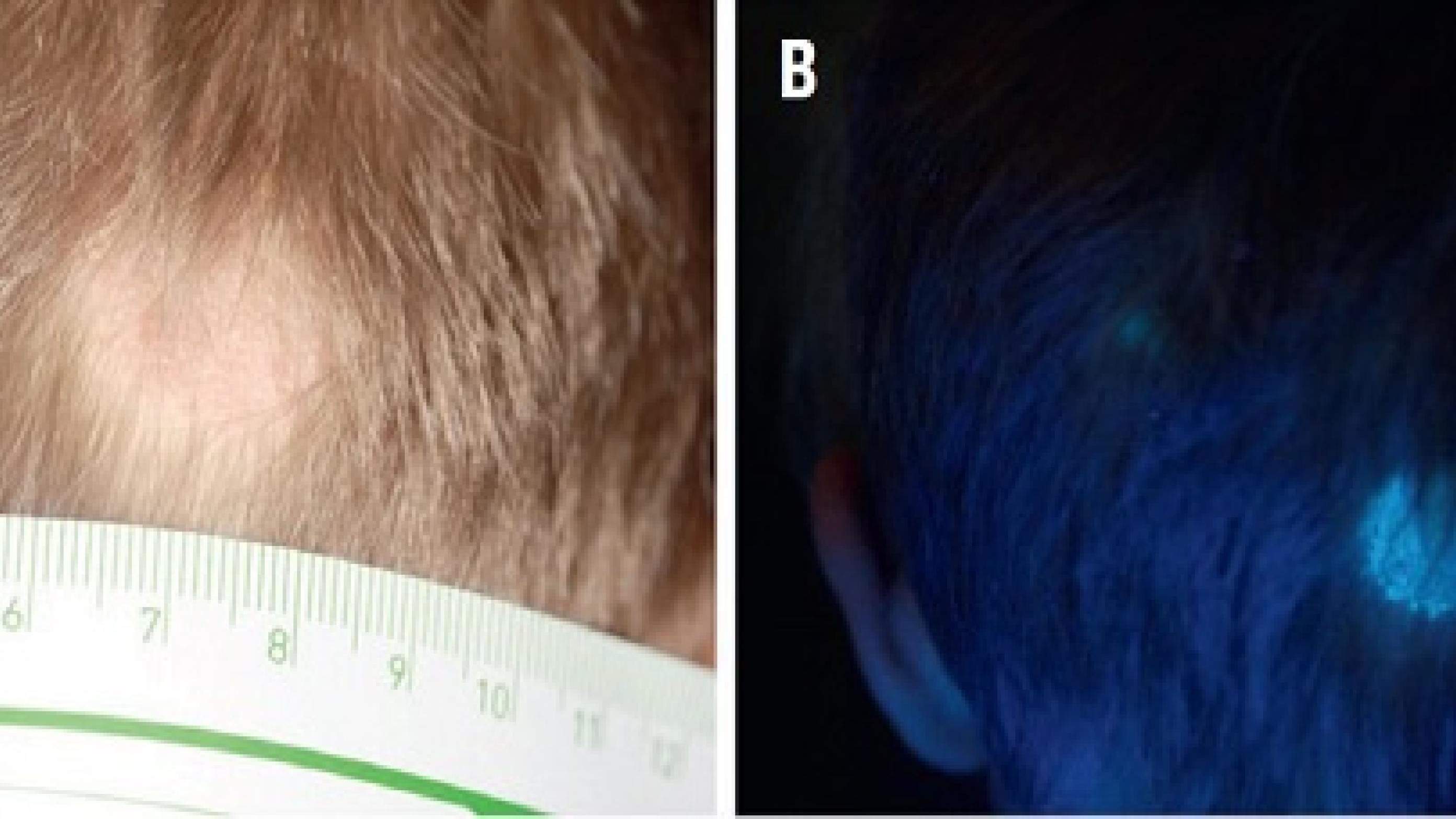 A. Klinisk præsentation af tinea capitis forårsaget af Microsporum canis. B. Samme patient som på billede A, her undersøgt med Wood’s light. M. canis fluorescerer med en lys grønlig farve.