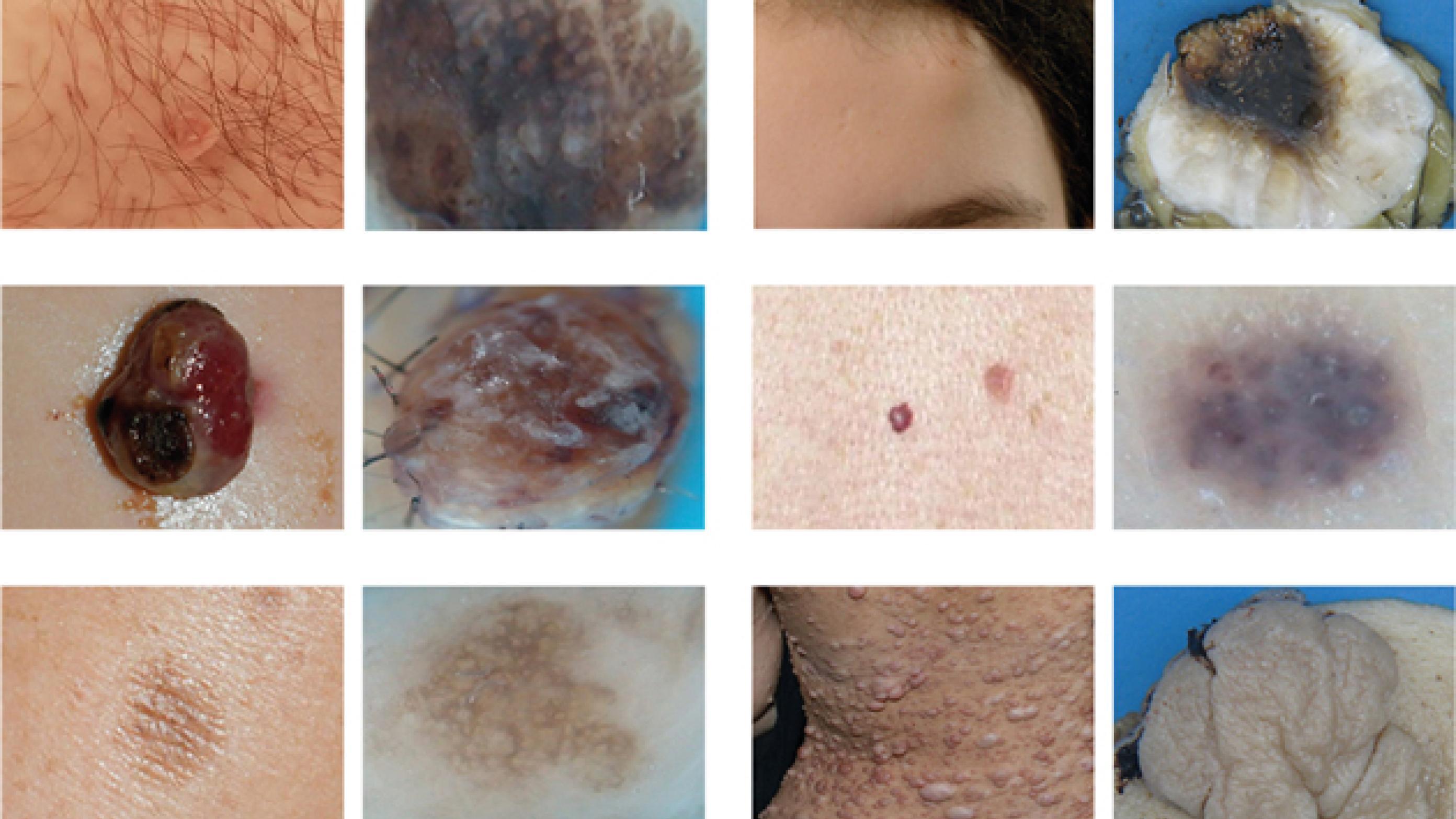 Kliniske og dermatologiske/patologiske billeder af benigne hudforandringer