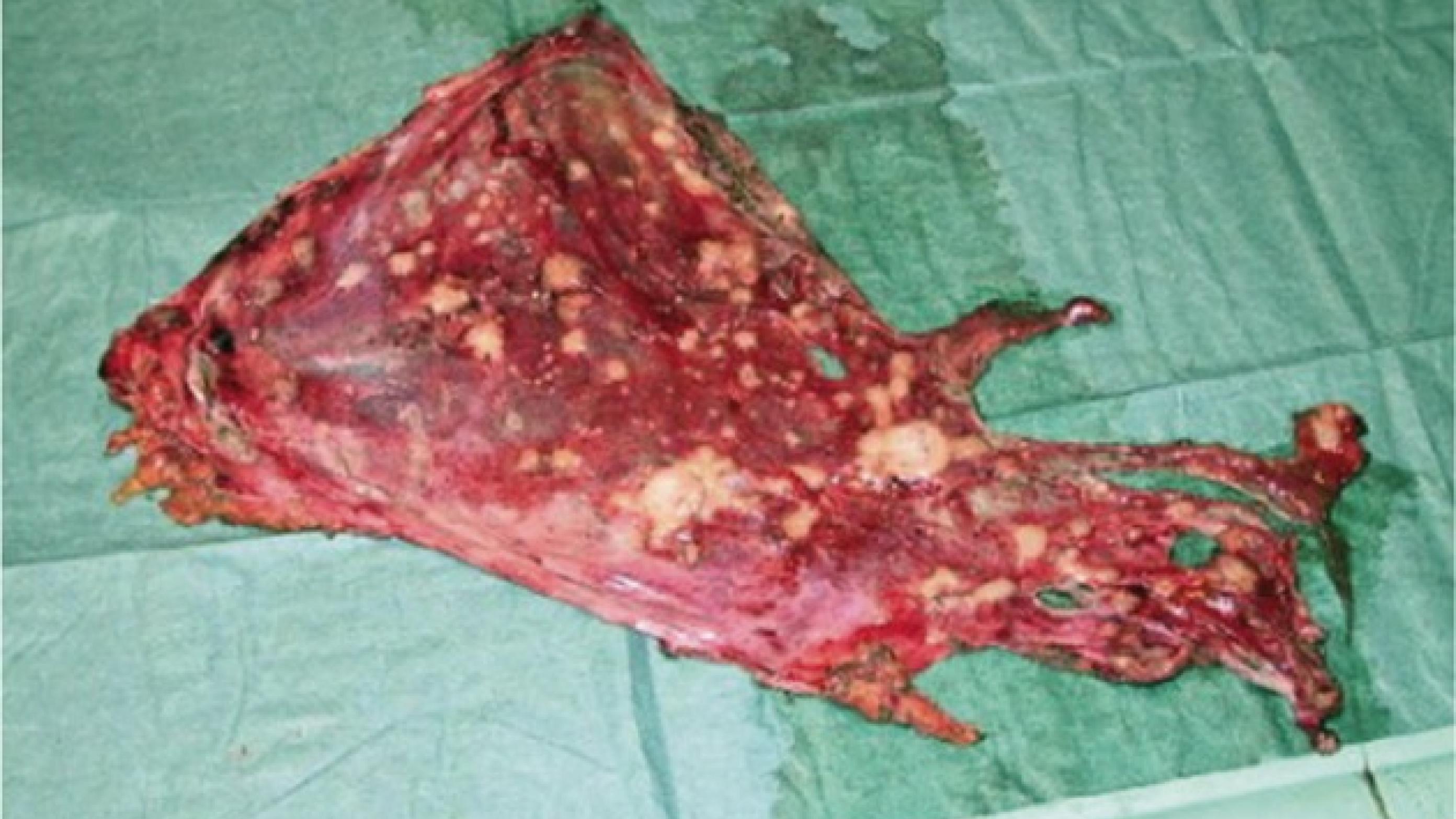 Peritoneum med metastaser